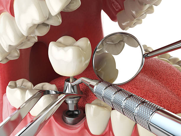 Best Emergency Tooth Extraction in Las Lomas, CA